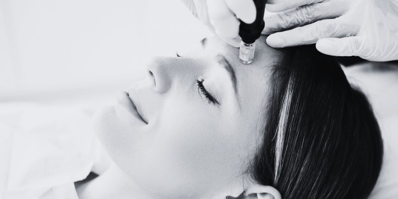 A person with closed eyes is lying down, receiving a microneedling facial treatment. A gloved hand is using a microneedling device on their forehead. The image is in black and white, illustrating expert skin care in Wake County.