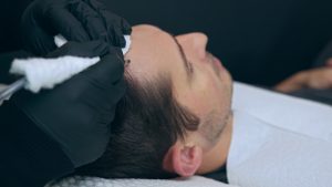 A person receiving a hairline tattoo procedure. The individual is lying on their back with their head turned to the side. A technician wearing black gloves is applying the tattoo with a device, while holding a cloth against the person's forehead.