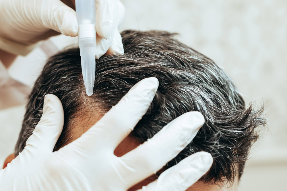 A person with dark hair is having a liquid applied to their scalp using a pointed applicator bottle. Hands in white gloves are parting the hair to ensure precise application.