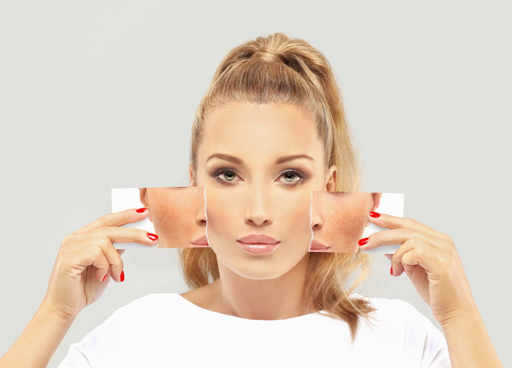 A woman with light brown hair in a ponytail holds photos of her cheeks showing skin blemishes. She stands in front of a light gray background, wearing a white top, with a focused expression.