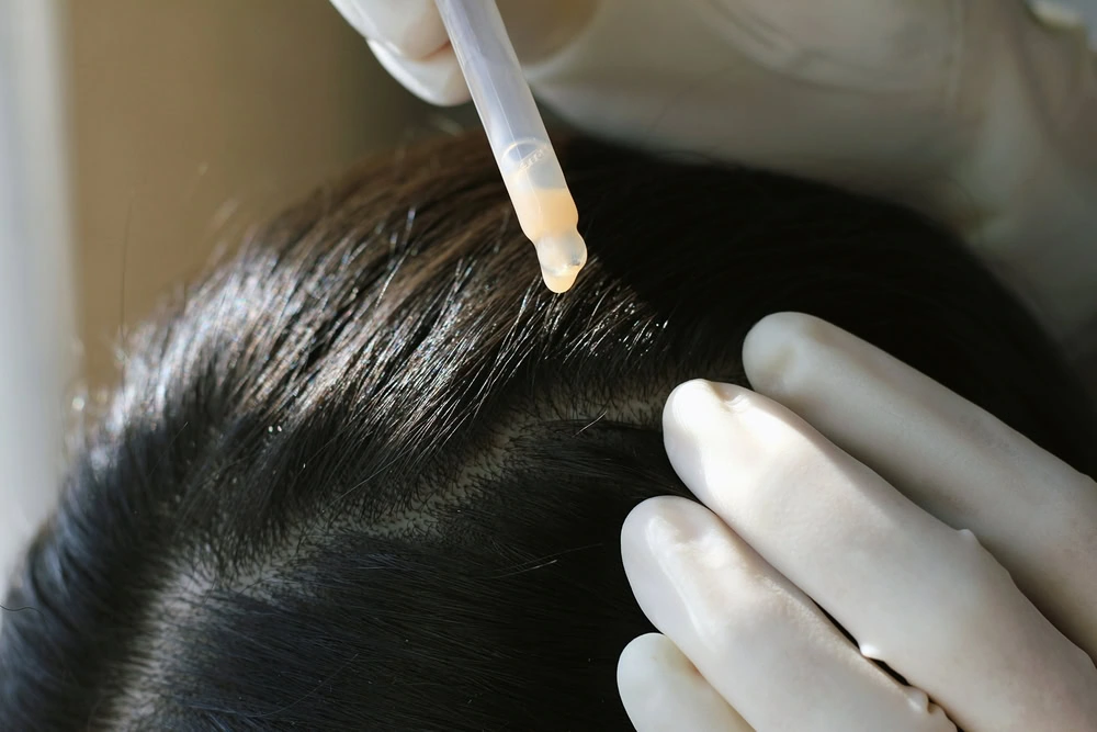 Close-up of a person's scalp with dark hair. A gloved hand holds a dropper, applying a liquid to the scalp.