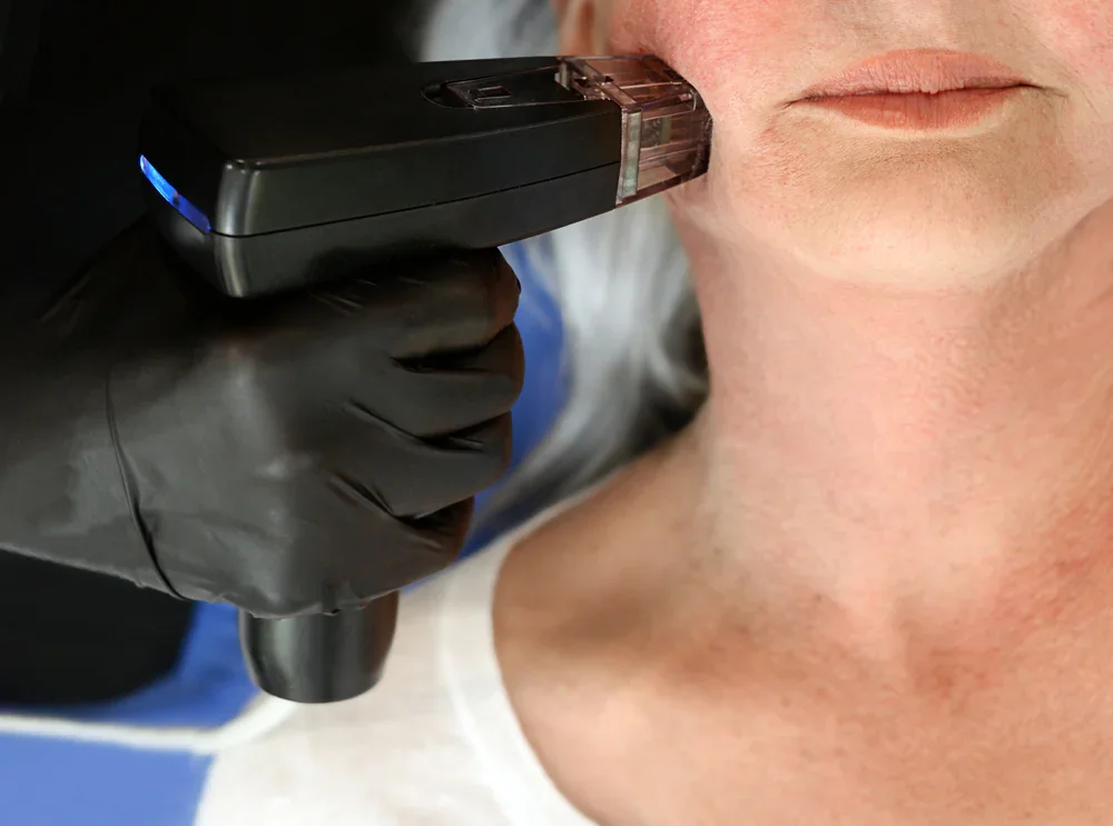 A person with gray hair receives a cosmetic skin treatment on the lower face using Lumecca by Inmode, operated by someone wearing black gloves.